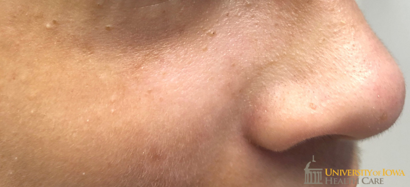 Tiny skin-colored to pearly papules, some with focal areas of pigment, on the cheeks and nose. (click images for higher resolution).